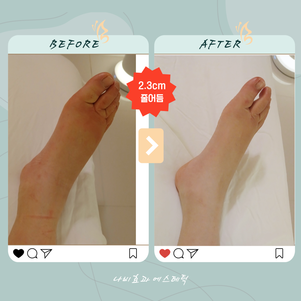 종아리 둘레 변화 기록